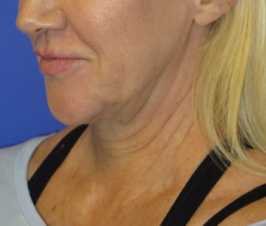 FACEology Lift / Neck Lift