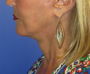 FACEology Lift / Neck Lift