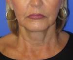 FACEology Lift / Neck Lift