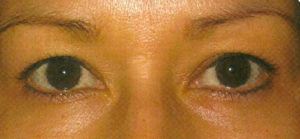 Eyelid Lift Case 5478 Before Photo Eyelid Lift