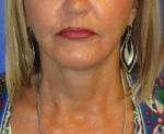 FACEology Lift / Neck Lift