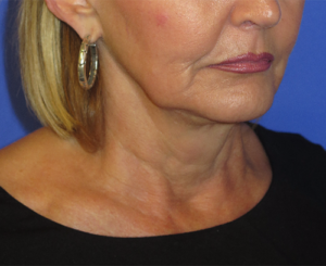 FACEology Lift / Neck Lift