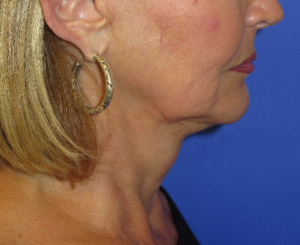 FACEology Lift / Neck Lift