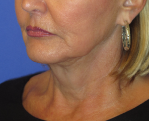 FACEology Lift / Neck Lift