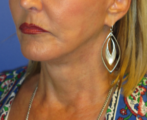 FACEology Lift / Neck Lift