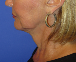 FACEology Lift / Neck Lift