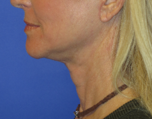 FACEology Lift / Neck Lift