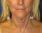 FACEology Lift / Neck Lift