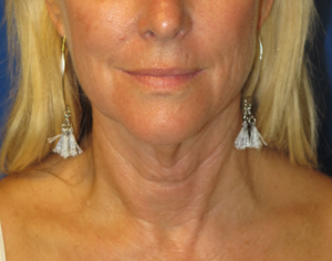 FACEology Lift / Neck Lift