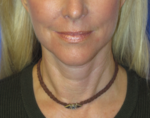 FACEology Lift / Neck Lift