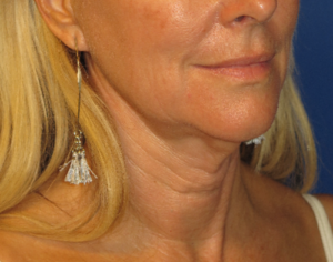 FACEology Lift / Neck Lift