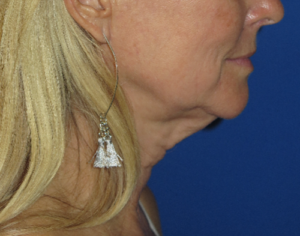 FACEology Lift / Neck Lift