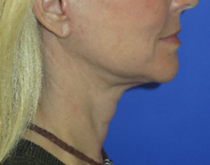 FACEology Lift / Neck Lift