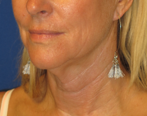 FACEology Lift / Neck Lift