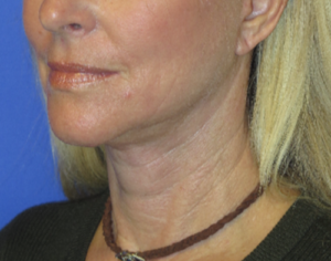 FACEology Lift / Neck Lift