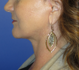 FACEology Lift / Neck Lift Case 5714 After Photo FACEology Lift / Neck Lift