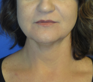 FACEology Lift / Neck Lift Case 5714 Before Photo FACEology Lift / Neck Lift