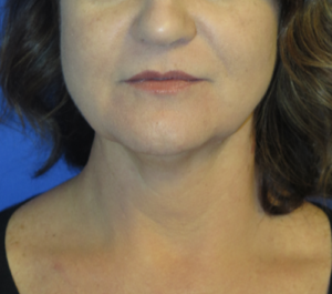 FACEology Lift / Neck Lift