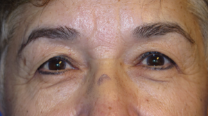 Eyelid Lift Case 5491 Before Photo Eyelid Lift