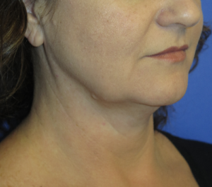 FACEology Lift / Neck Lift Case 5714 Before Photo FACEology Lift / Neck Lift