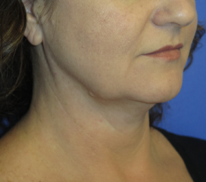 FACEology Lift / Neck Lift