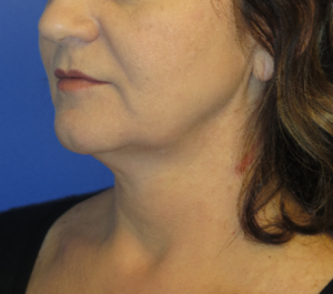FACEology Lift / Neck Lift Case 5714 Before Photo FACEology Lift / Neck Lift