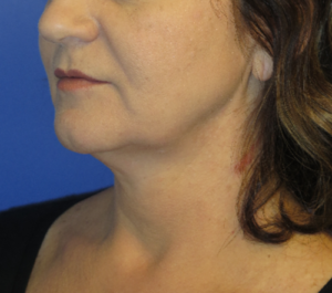 FACEology Lift / Neck Lift