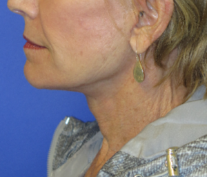 FACEology Lift / Neck Lift Case 5703 After Photo FACEology Lift / Neck Lift