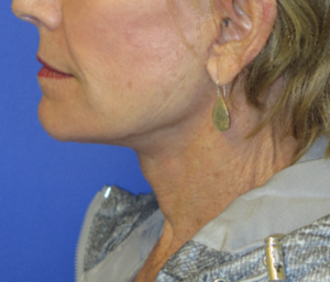 FACEology Lift / Neck Lift