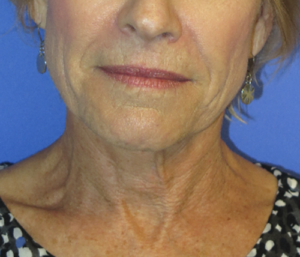 FACEology Lift / Neck Lift Case 5703 Before Photo FACEology Lift / Neck Lift