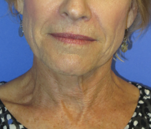 FACEology Lift / Neck Lift