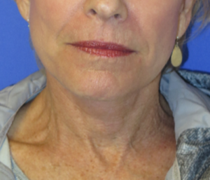 FACEology Lift / Neck Lift Case 5703 After Photo FACEology Lift / Neck Lift