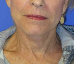 FACEology Lift / Neck Lift