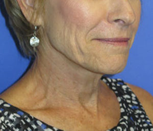 FACEology Lift / Neck Lift Case 5703 Before Photo FACEology Lift / Neck Lift