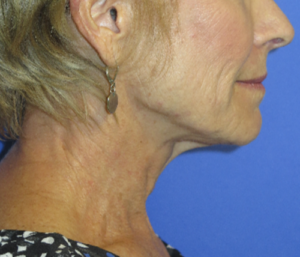 FACEology Lift / Neck Lift Case 5703 Before Photo FACEology Lift / Neck Lift