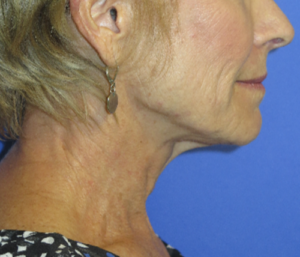 FACEology Lift / Neck Lift