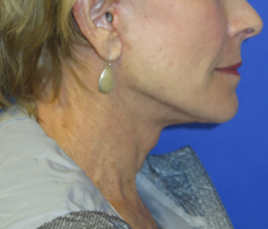 FACEology Lift / Neck Lift Case 5703 After Photo FACEology Lift / Neck Lift