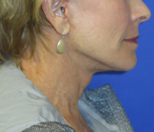 FACEology Lift / Neck Lift