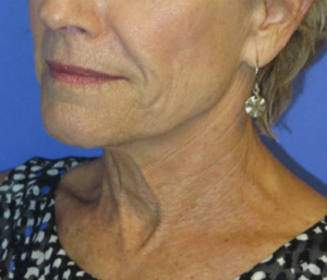 FACEology Lift / Neck Lift Case 5703 Before Photo FACEology Lift / Neck Lift