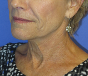 FACEology Lift / Neck Lift