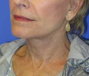 FACEology Lift / Neck Lift Case 5703 After Photo FACEology Lift / Neck Lift