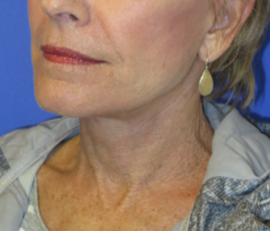 FACEology Lift / Neck Lift