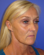 FACEology Lift / Neck Lift