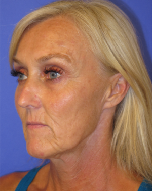 FACEology Lift / Neck Lift Case 5575 Before Photo FACEology Lift / Neck Lift