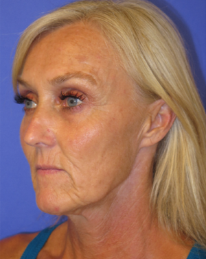 FACEology Lift / Neck Lift