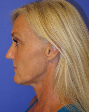 FACEology Lift / Neck Lift Case 5575 Before Photo FACEology Lift / Neck Lift
