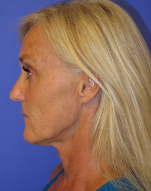 FACEology Lift / Neck Lift