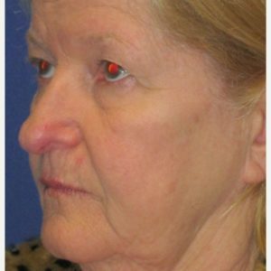 Laser Resurfacing Case 5378 Before Photo Laser Resurfacing