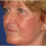 Laser Resurfacing