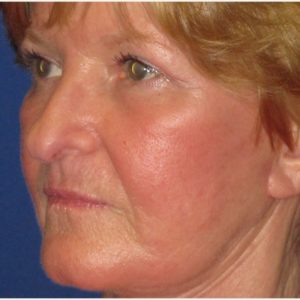 Laser Resurfacing Case 5378 After Photo Laser Resurfacing